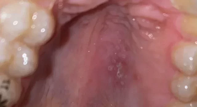 Roof of mouth sore