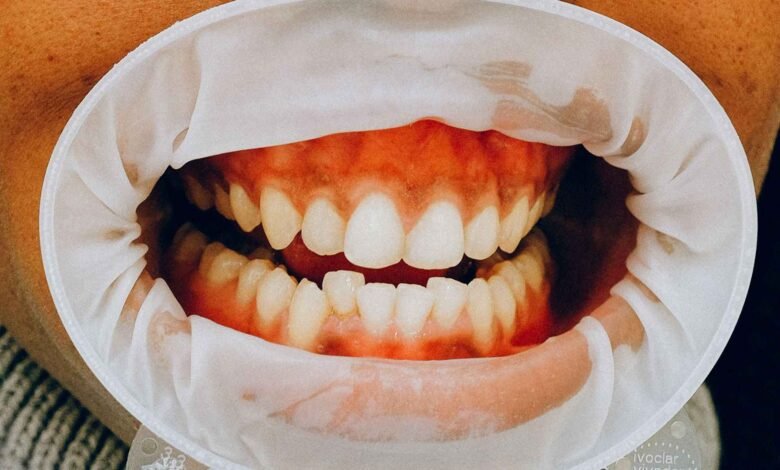 How Long Can You Keep Your Teeth With Periodontal Disease