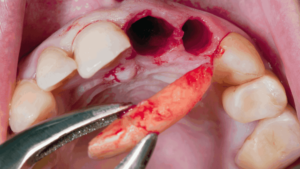 how painful is tooth extraction without anesthesia